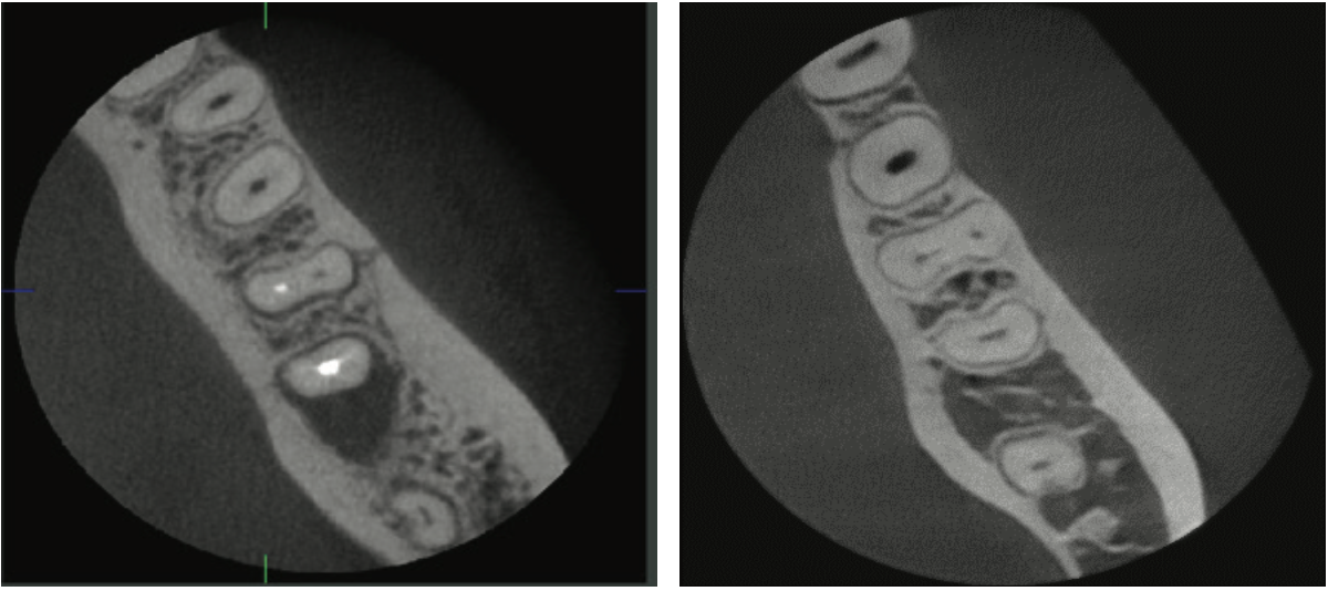 Green X 21 Endo 모드 고해상도 근관 영상
