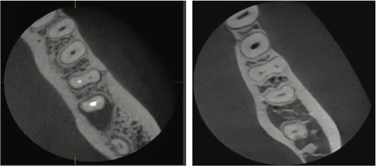 Green X 21 Endo 모드 고해상도 근관 영상