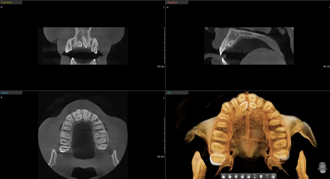 CBCT 시상면 영상 샘플