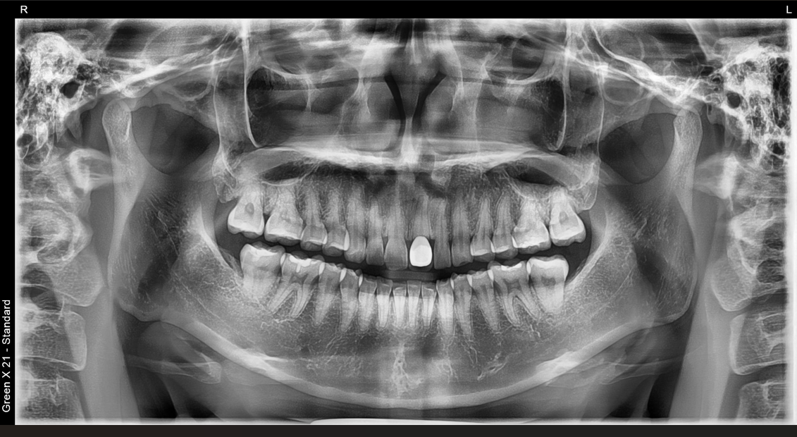디지털 파노라마 영상 샘플